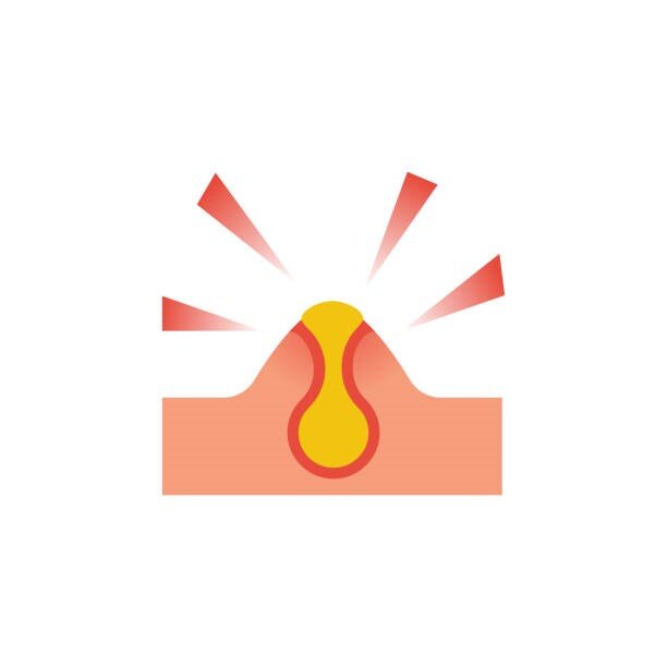 کورک پوستی یا دمل چیست؟