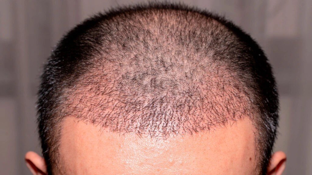 آیا کاشت مو دائمی است یا احتمال ریزش مجدد وجود دارد؟ بررسی واقعیتها