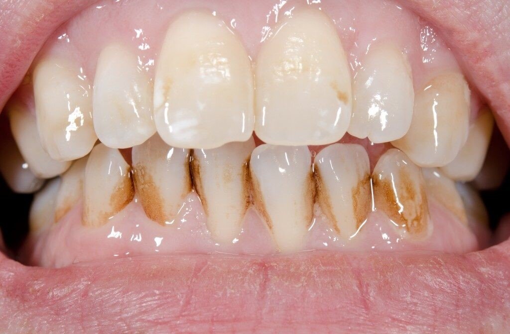 رنگ دندان ها چه چیزی درباره سلامت شما می‌گوید؟ | خطرناک ترین لکه چه رنگی است؟