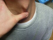 سیب آدم چیست و چگونه می‌توان آن را از بین برد؟