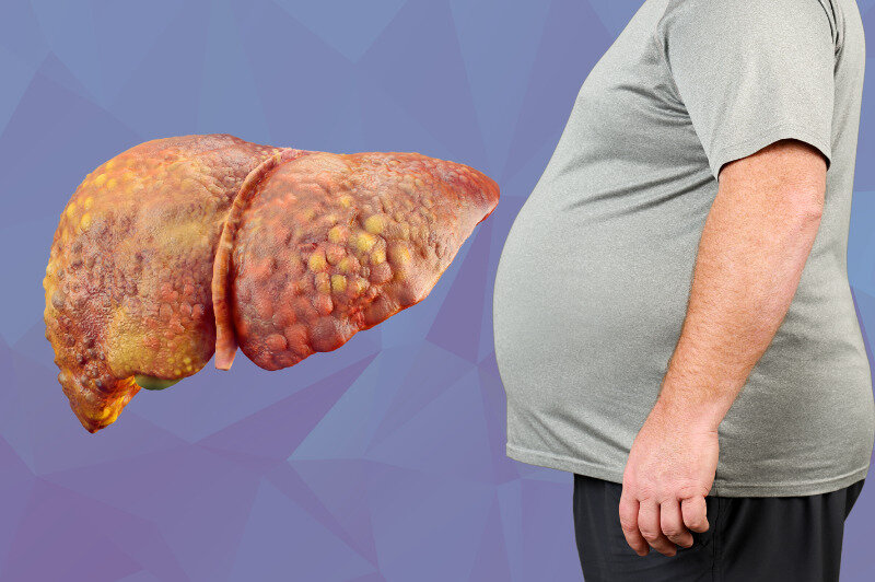 یک داروی ضد چاقی علیه کبد چرب