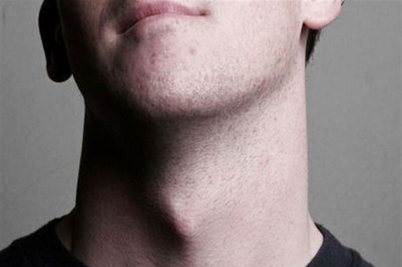 سیب آدم چیست و چگونه میتوان آن را از بین برد؟