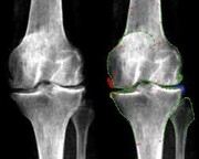 نکته بهداشتی روز: پوکی استخوان و یائسگی