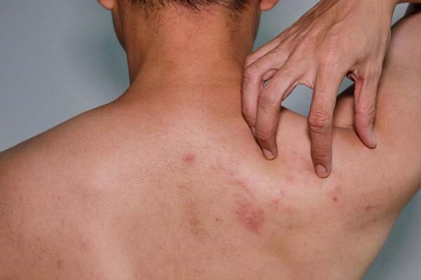 جوش روی کمر نشانه چیست و چگونه درمان میشود؟