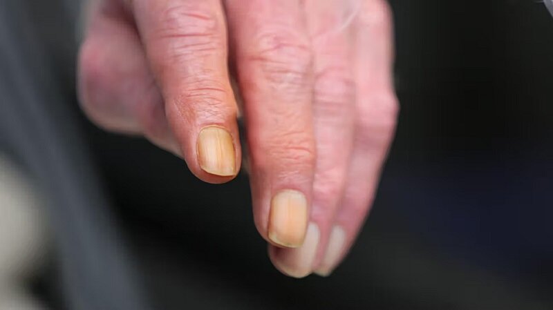 ناخنهای شما خبر از بیماریتان میدهند