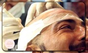 چه کسانی کاندیدای مناسب کاشت مو هستند؟ | نشانه‌ها و معیارهای مهم قبل از عمل