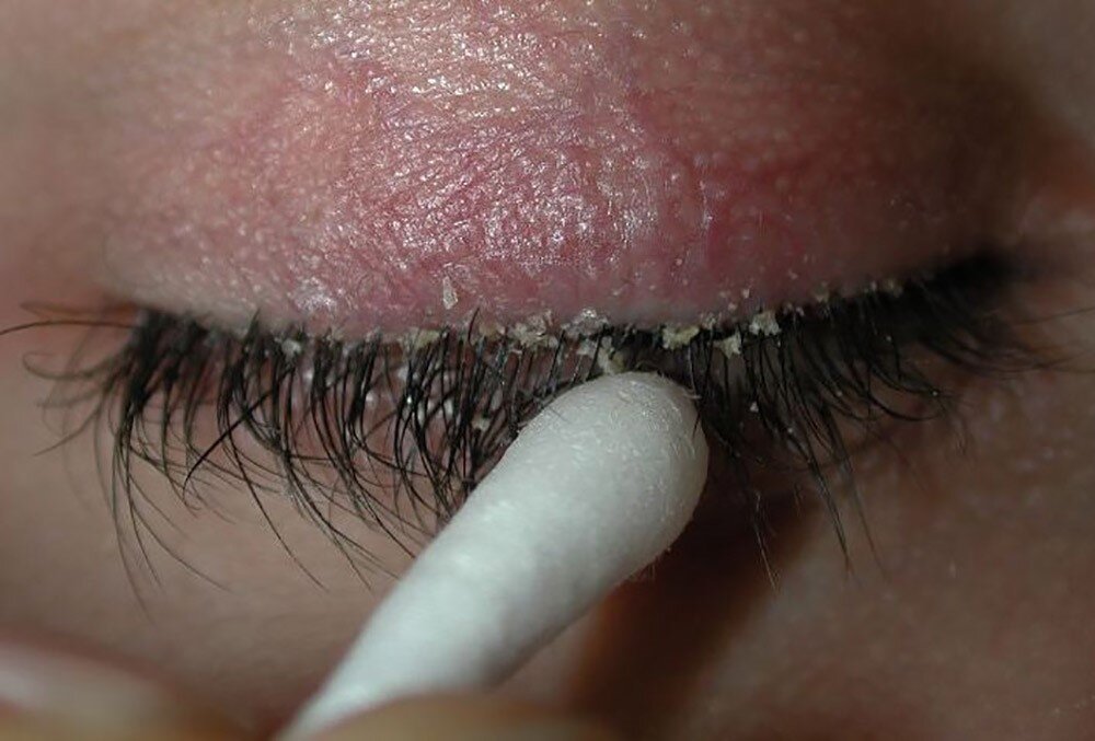 بلفاریت چشم چیست و چگونه درمان میشود؟