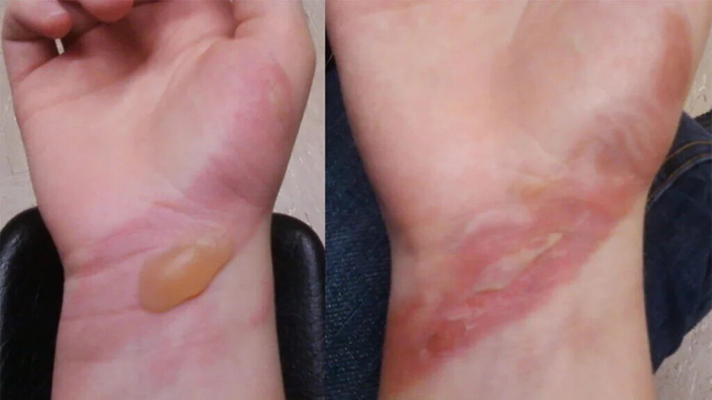 سوختگی درجه سه چیست و چگونه درمان میشود؟