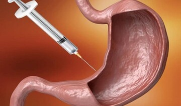 میان‌بر خطرناک لاغری | هیچ جای دنیا به اندازه ایران بوتاکس معده نمی زنند