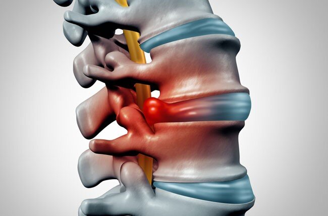 تفاوت دیسک کمر و عصب سیاتیک چیست؟