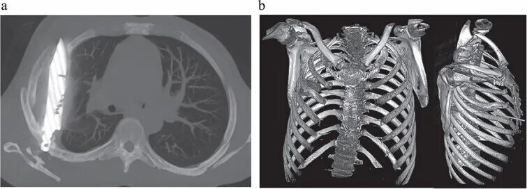 اتفاق باورنکردنی؛ چاقویی که ۱۰سال در سینه این مرد فرو رفته بود و نمیدانست + عکس