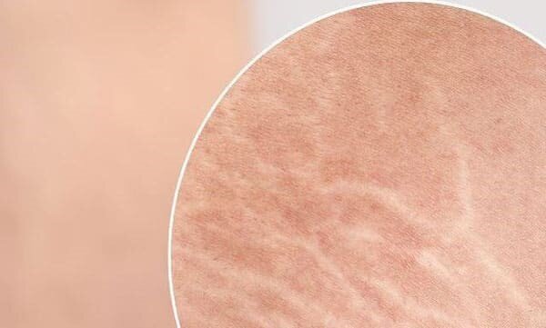 ترک‌های پوستی