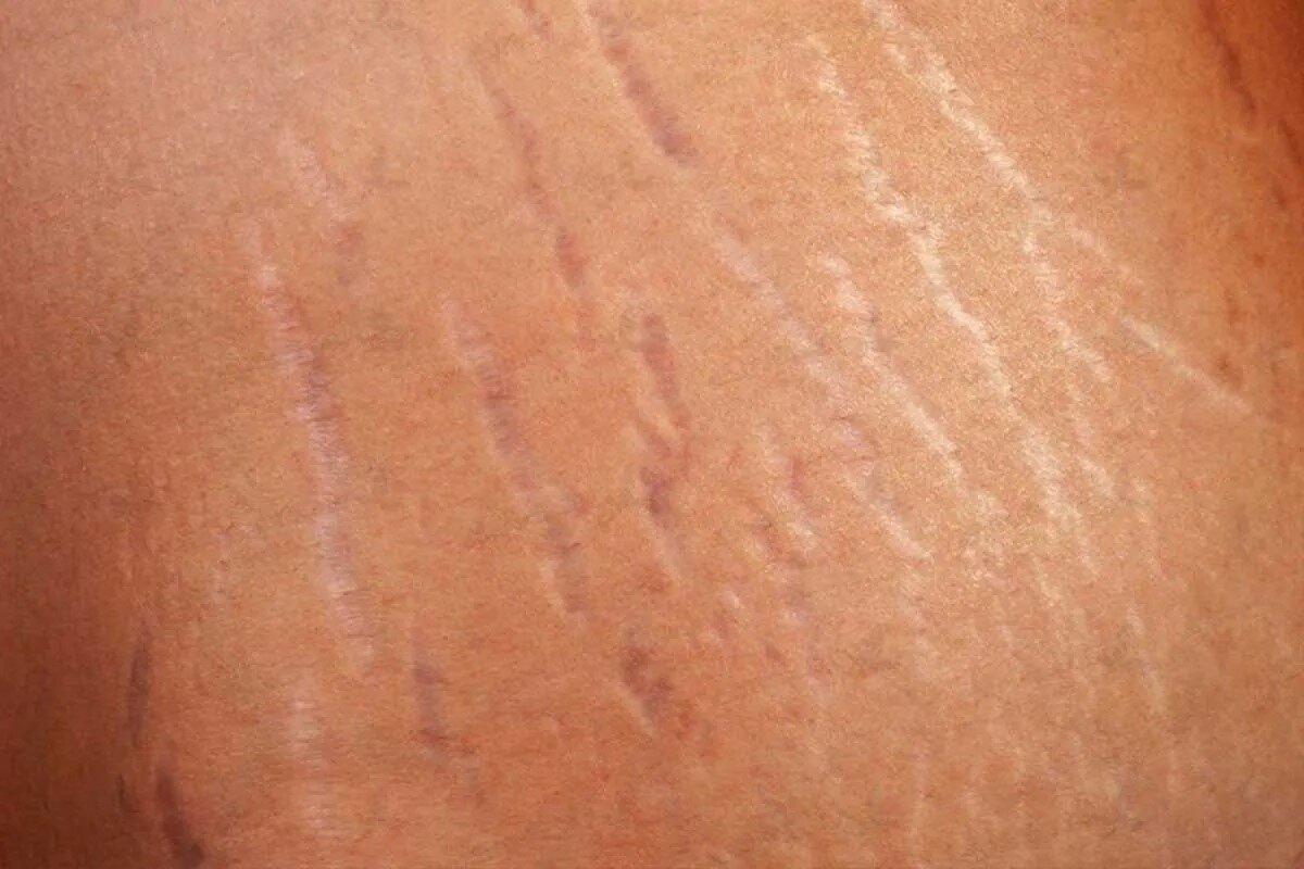 ترکهای پوستی؛ علل ایجاد و روشهای درمان