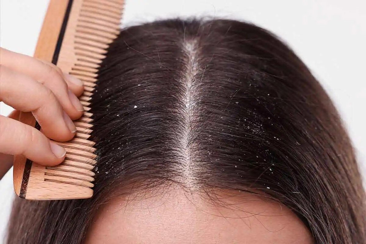 تفاوت پوسته سر و شوره سر ؛ علت، علائم و روش درمان پوسته سر