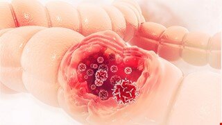 خونریزی گوارشی، احتمال بروز سرطان در این گروه سنی colon