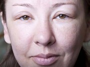 ورم صورت؛ علل شایع، روش‌های درمان و راهکارهای خانگی