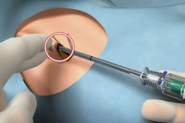 ترک اعتیاد، تضمینی با «آهسته»