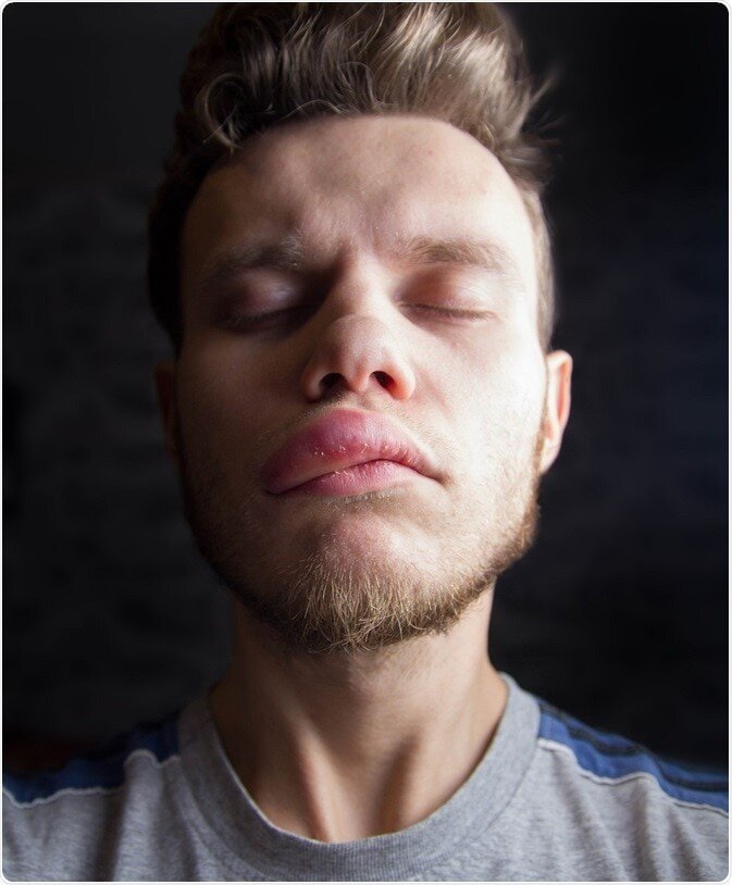 ورم صورت؛ علل شایع، روشهای درمان و راهکارهای خانگی