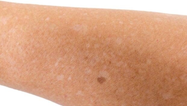 آشنایی با انواع لکهای پوستی