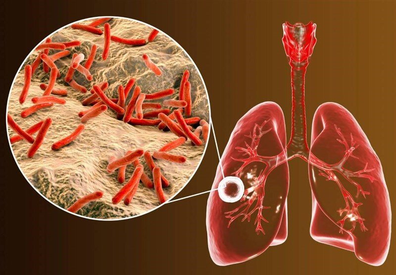 ابتلای ۶ هزار ایرانی به یک بیماری خطرناک ریوی | ۸ استان در صدر شیوع بیماری بیماری سل - بیماری ریوی