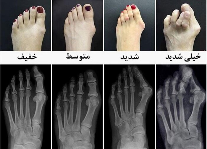برای اصلاح انگشتان خم شده پا چه کار کنیم؟