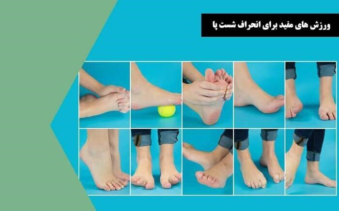 برای اصلاح انگشتان خم شده پا چه کار کنیم؟