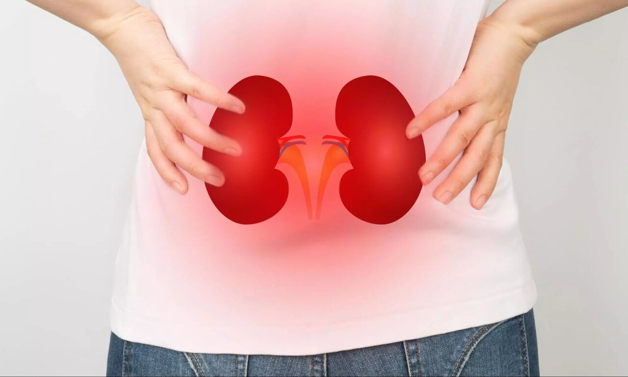 فعالیت در این ساعت ریسک سنگ کلیه را افزایش میدهد kidney