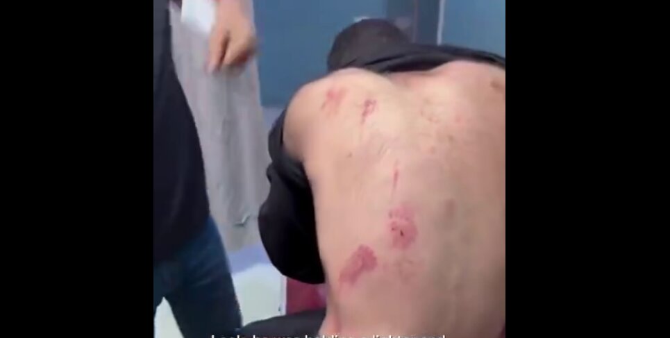 تصاویر تلخ از آثار شکنجه بر بدن زندانیان سابق اردوگاه جنین | ببینید