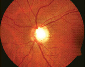 glaucoma