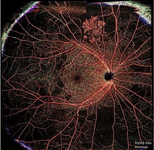 چشمها دریچهای به سلامت قلب هستند retina