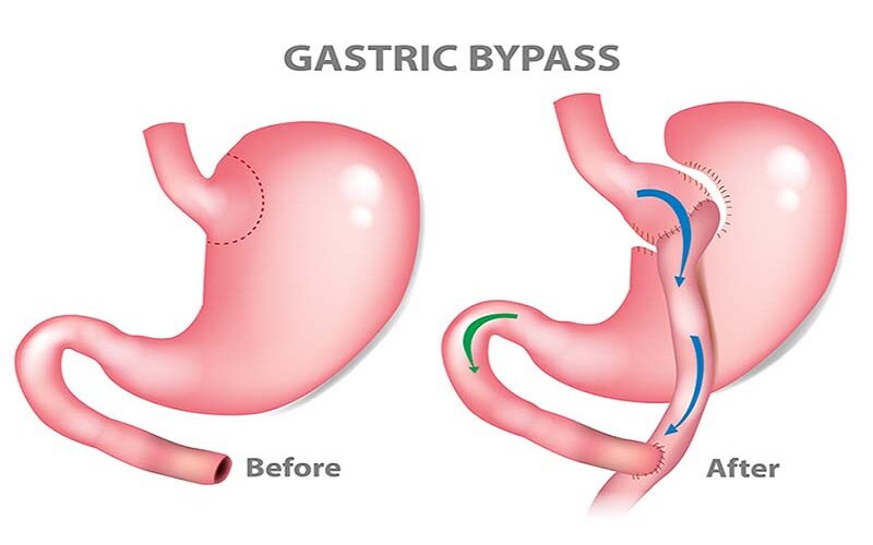 بهترین روش جراحی لاغری