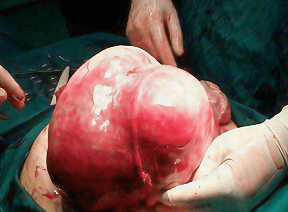 این توده وحشتناک و ۷کیلویی از رحم بیمار اردبیلی خارج شد + عکس