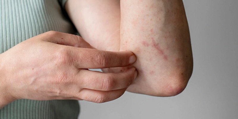 علائم ابتلا به دیابت در پوست