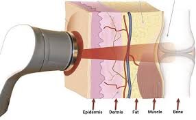 این نور درد را خاموش می‌کند | اسرار  پنهان فوتون‌ها؛  از بهبود زخم تا اثرات چشمگیر بر مغز