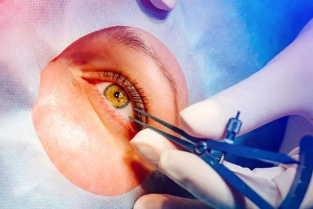 انجام سالانه ۷۰۰۰ عمل پیوند قرنیه در ایران | تنها ۱۵ درصد خانواده‌ها اجازه اهدای قرنیه می‌دهند