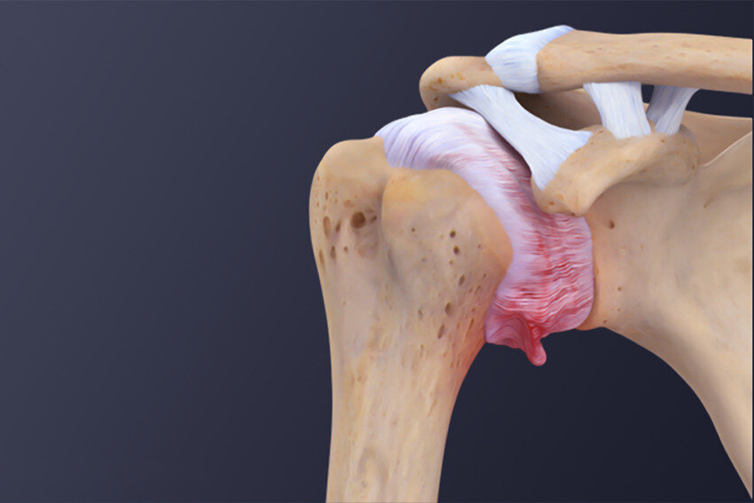 دردی مرموز که ناگهان شانه تان را قفل می کند! | شانه یخ زده چیست؟ + علل و درمان