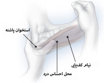 درمان‌های خانگی برای درد پاشنه پا