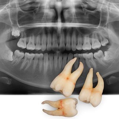 رادیوگرافی فک با دندان‌های عقل کشیده‌شده و ریشه‌های خمیده