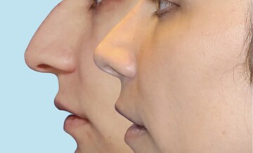 رونمایی از اولین جراحی «بینی قوزدار» در ایران؛ آیا واقعا قوز بینی ترند زیبایی سال ۲۰۲۶ است؟