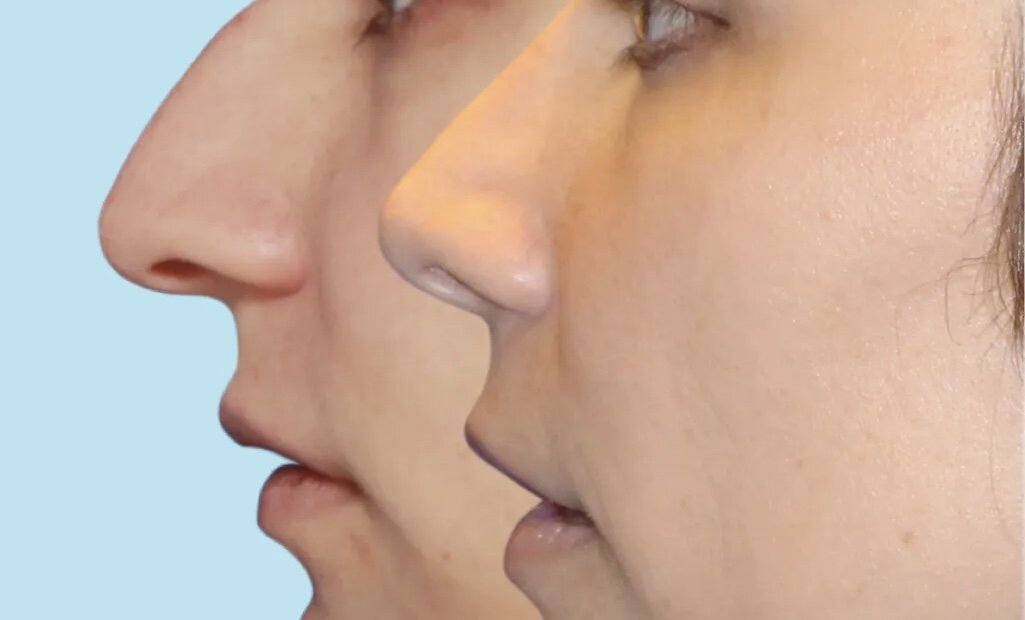 رونمایی از اولین جراحی «بینی قوزدار» در ایران؛ آیا واقعا قوز بینی ترند زیبایی سال ۲۰۲۶ است؟