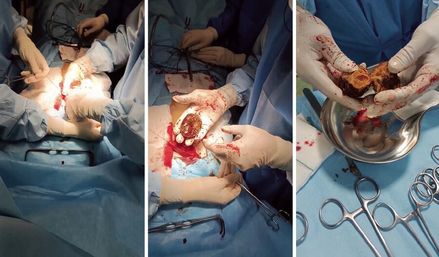 توده عجیب خرمالو در معده چند بیمار + عکس