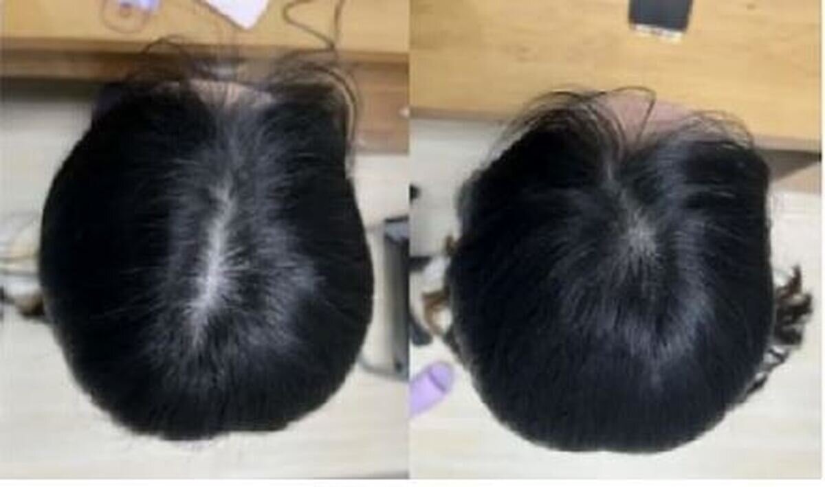 آخرین متد درمان طاسی