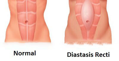 شکاف عضلات راست شکمی پس از زایمان: از تحقیقات پایه تا عمل بالینی + عکس
