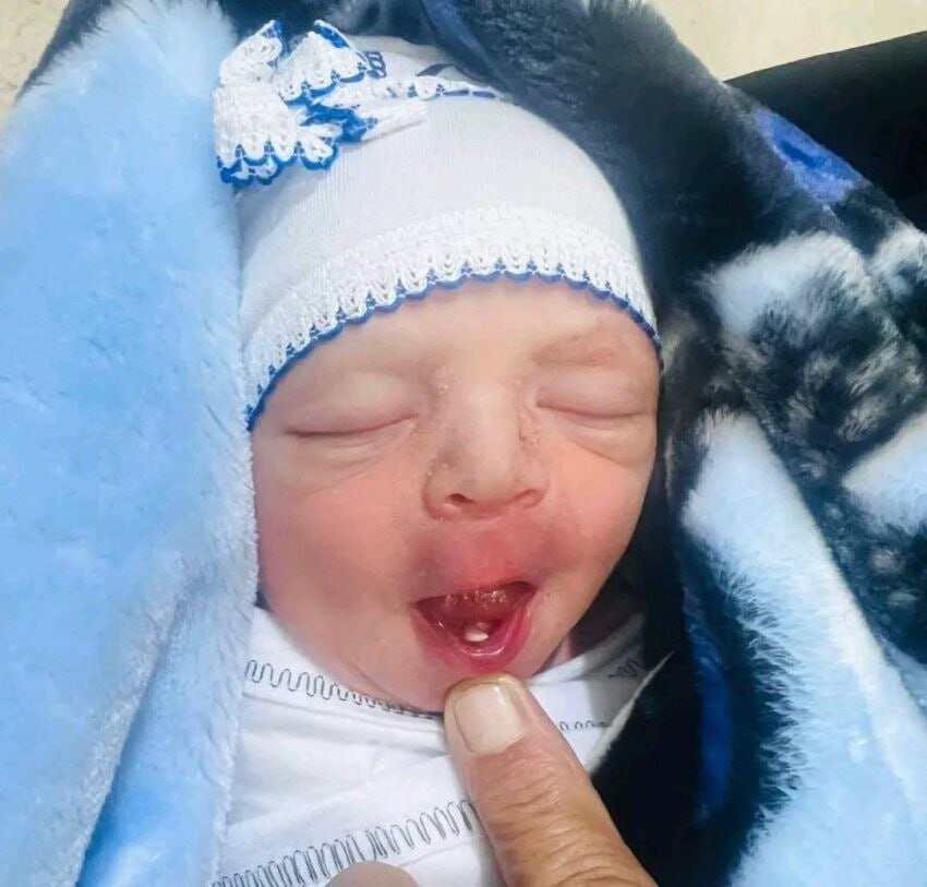 نوزادی که با دندان به دنیا آمد | عکس