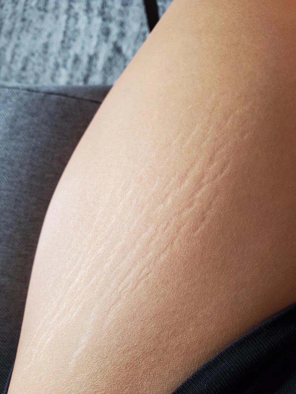 درمان ترکهای پوستی؛ «درمان قطعی» وجود دارد؟