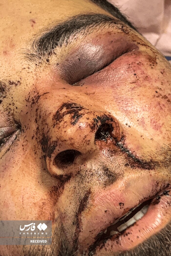 تصاویر دردناک از وضعیت وحشتناک مجروحان حملات داعشی‌وار به مردم