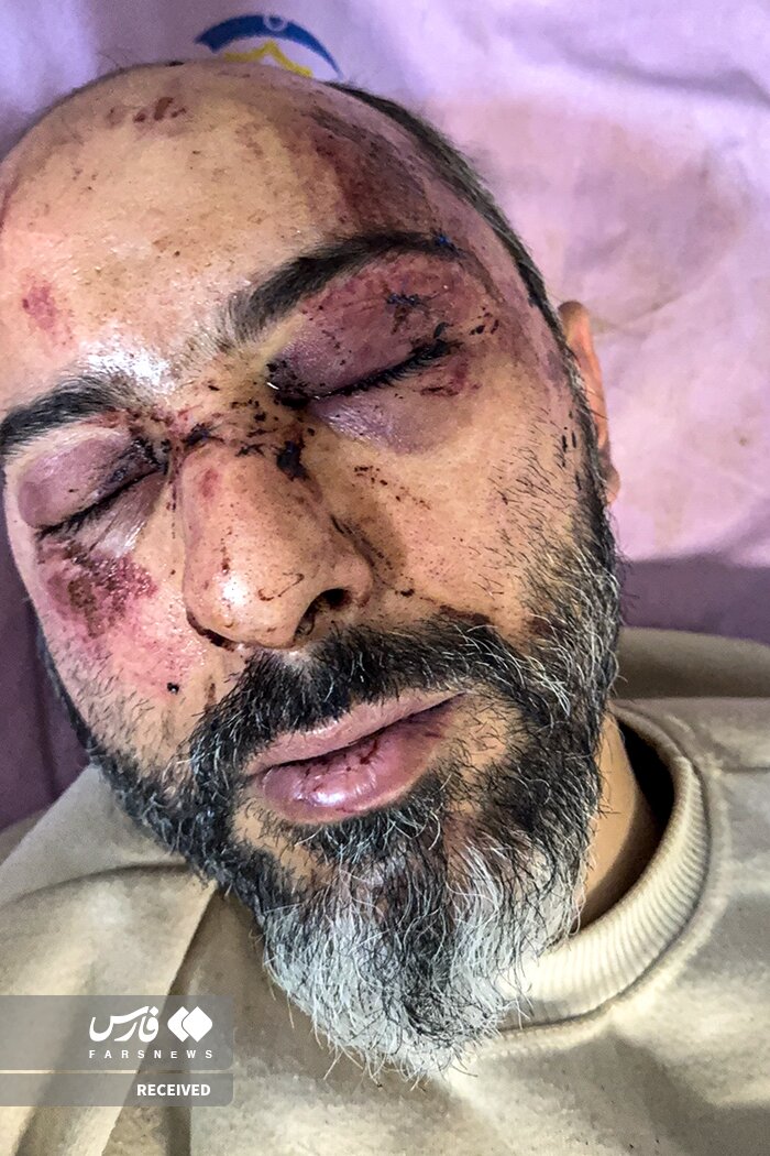 تصاویر دردناک از وضعیت وحشتناک مجروحان حملات داعشی‌وار به مردم