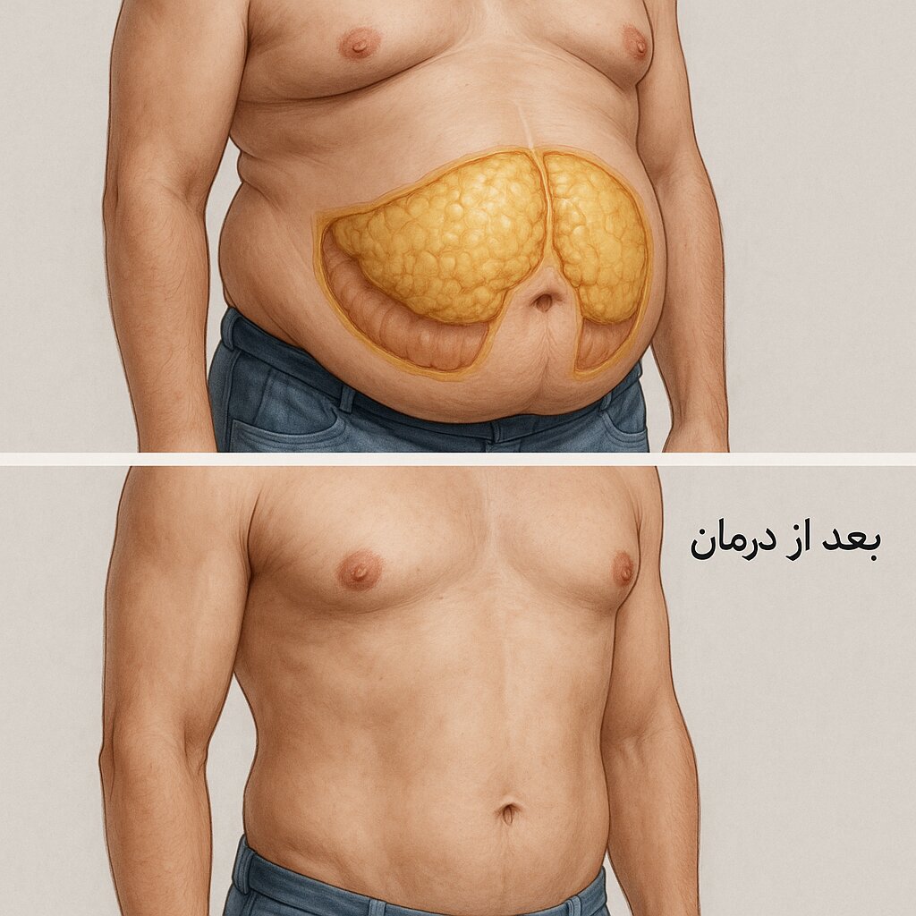 شکم کورتیزولی چیست؟