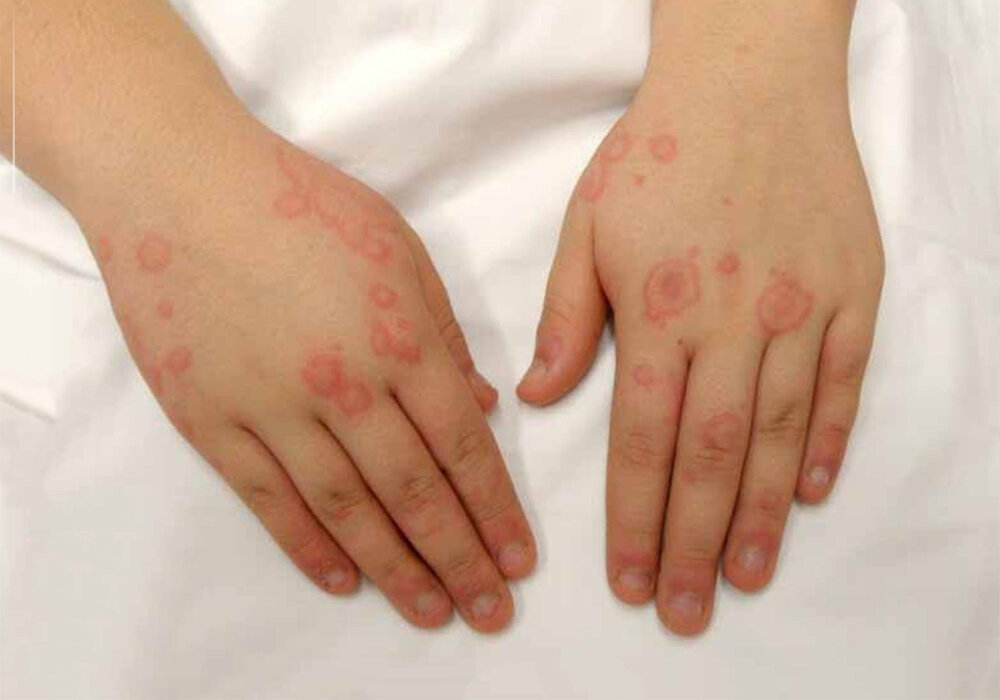 این بیماری در کودکان خطرناک‌تر است | چطور پیشگیری کنیم؟