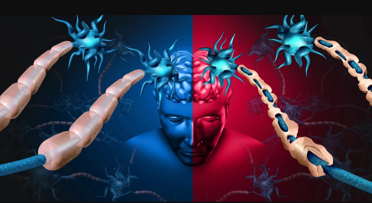 یافته‌ها درباره ام اس